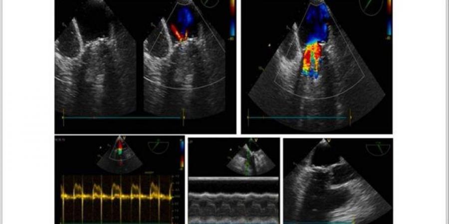 في مشفى الباسل لأمراض وجراحة القلب بدمشق… فريق طبي ينجح في علاج حالة نادرة لـ “أم الدم الكاذبة”