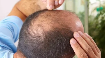 من أصابعك- طبيب يوضح طريقة للتنبؤ بالصلع الوراثي
