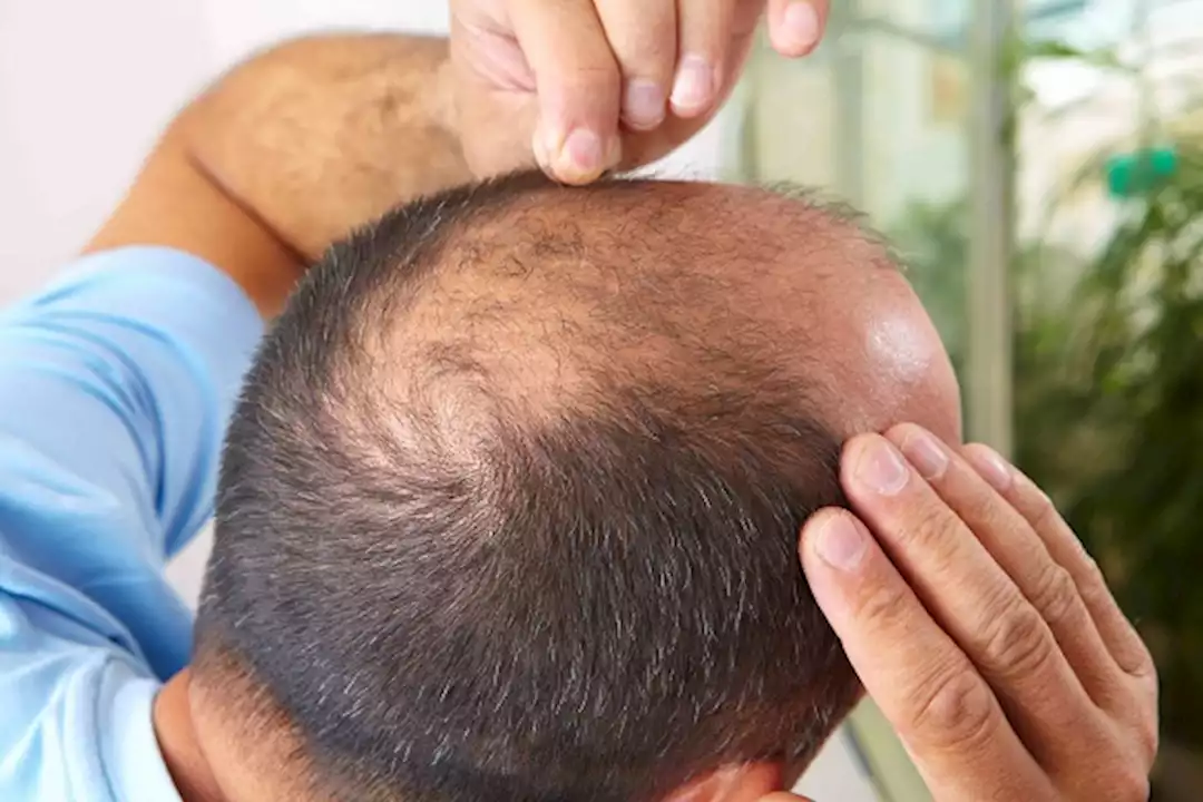 من أصابعك- طبيب يوضح طريقة للتنبؤ بالصلع الوراثي 5 من أصابعك- طبيب يوضح طريقة للتنبؤ بالصلع الوراثي