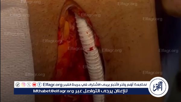 نجاح أول عملية زراعة شريان صناعي من البطن إلى الطرف السفلي بمستشفى السنبلاوين