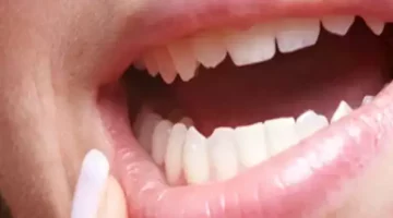 علاج فطريات الفم: وطريقة التخلص منها من المنزل وطبيعية للتخفيف منها