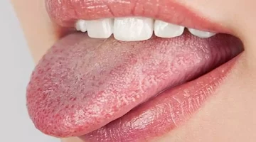 ألوان اللسان.. علام تدل؟