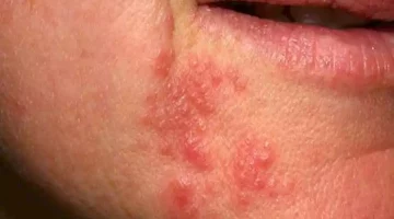 الارتكاريا النفسية.. كيف تحمي نفسك منها؟