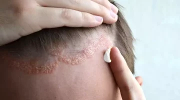 الأكزيما الدهنية.. إليك الأسباب وطرق العلاج