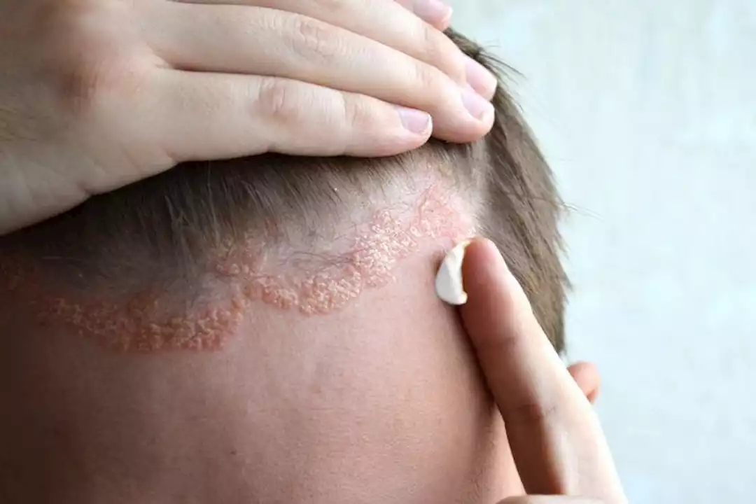الأكزيما الدهنية.. إليك الأسباب وطرق العلاج 5 الأكزيما الدهنية.. إليك الأسباب وطرق العلاج