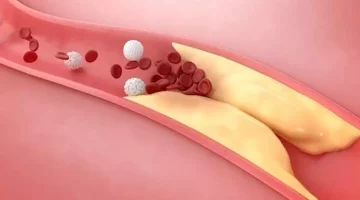 هل كل الدهون تؤدي لارتفاع الكوليسترول؟
