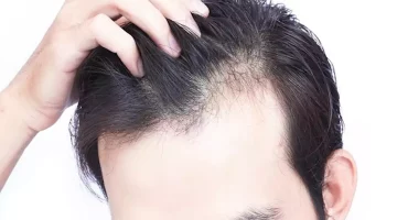 سبب غريب لتساقط الشعر..كيف تتعامل معه؟