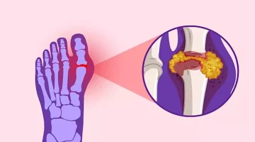 انتبه- 5 أعراض غير عادية لمرض النقرس
