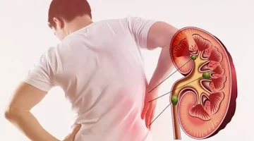 علامات مبكرة تنذرك بحصوات الكلى