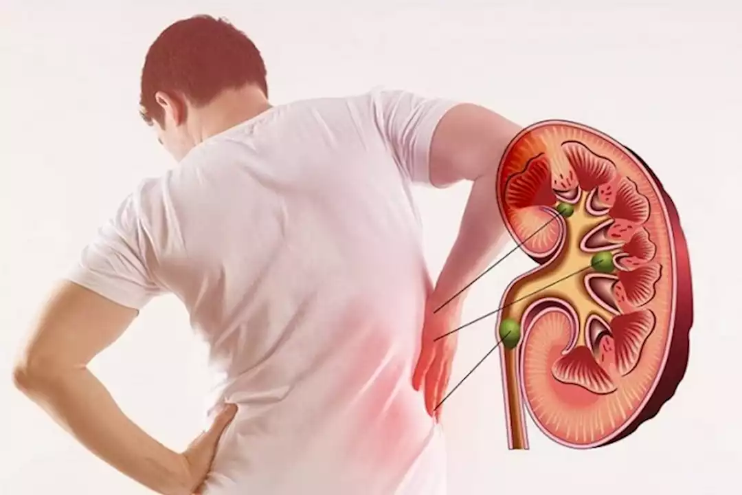 علامات مبكرة تنذرك بحصوات الكلى
