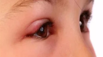 5 أسباب لتورم العينين.. إليك طرق علاجها