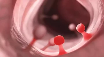حسام موافي يحذر من زوائد القولون: خطيرة في هذه الحالة