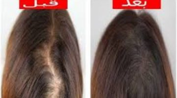 وصفات طبيعية وسهلة لتقوية جذور الشعر في الشتاء