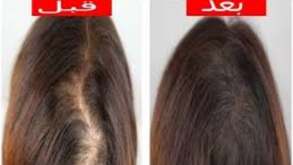 وصفات طبيعية وسهلة لتقوية جذور الشعر في الشتاء 5 وصفات طبيعية وسهلة لتقوية جذور الشعر في الشتاء
