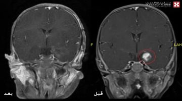 مستشفى الدكتور سليمان الحبيب بالخُبر يُنهي معاناة رضيعة مع ورمٍ بالدماغ تسبَّب في تشنجاتٍ صرعيّة حادّة