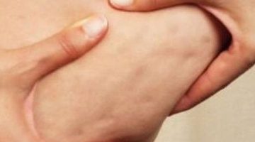 أسباب ظهور السيلوليت وطرق علاجها