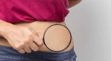 أسباب علامات تمدد الجلد وطرق علاجها