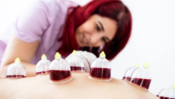 تعرف على فوائد الحجامة للنساء 5 تعرف على فوائد الحجامة للنساء