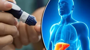 السكري ودهون الكبد- حسام موافي يوضح العلاقة بينهما