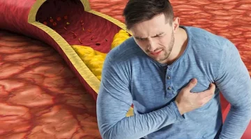 نصائح لتجنب ارتفاع الكوليسترول بالدم قبل العيد 
