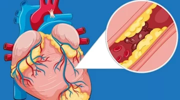 انسداد القلب- الأسباب والأعراض والعلاج