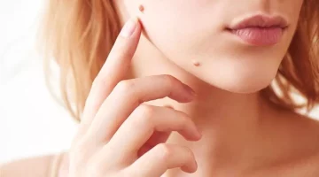 أسباب ظهور الشامات بعد سن الثلاثين- هل لها دلالات كثيرة؟