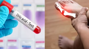أعراض ارتفاع حمض اليوريك- 7 علامات تتشابه مع أمراض أخرى