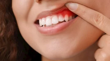 استشاري: الدورة الشهرية تزيد التهاب اللثة لهذه الأسباب