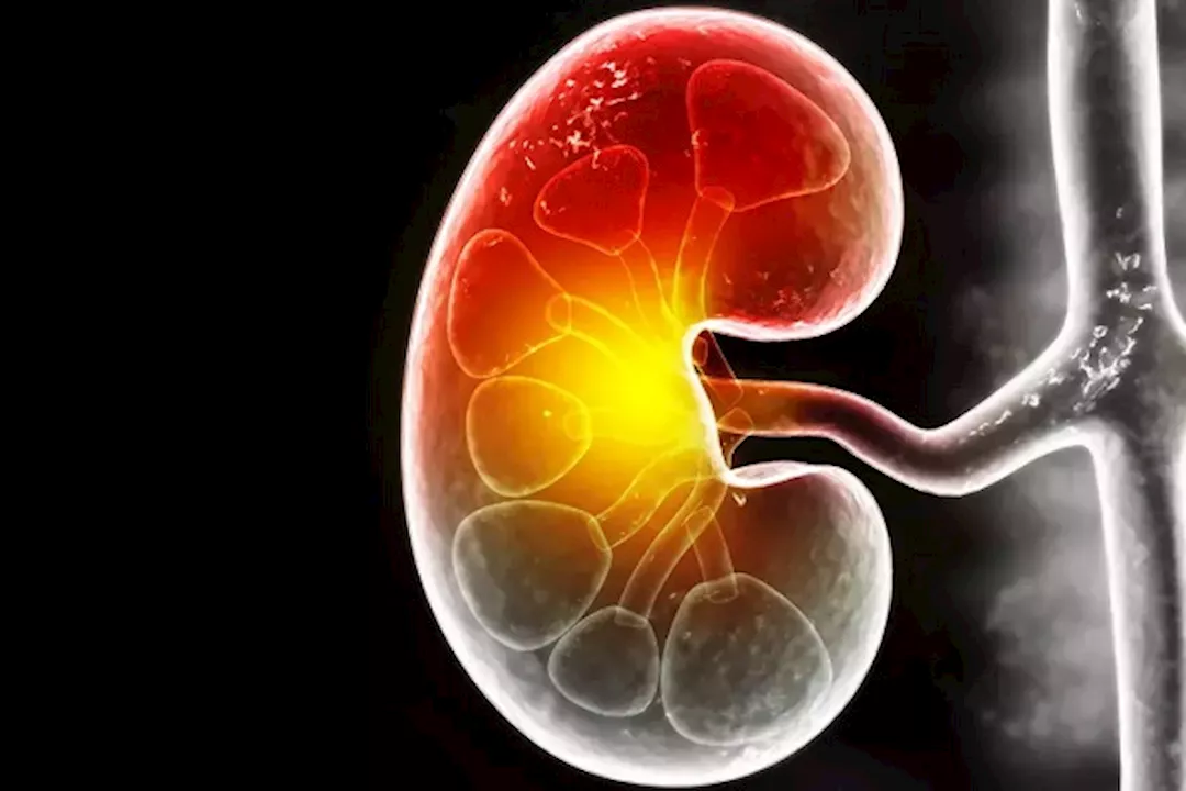 أعراض مرض الكلى المزمن 5 أعراض مرض الكلى المزمن